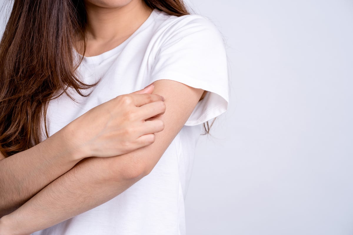 A Woman with Itching Scratching Her Arms Skin Caused by Eczema,